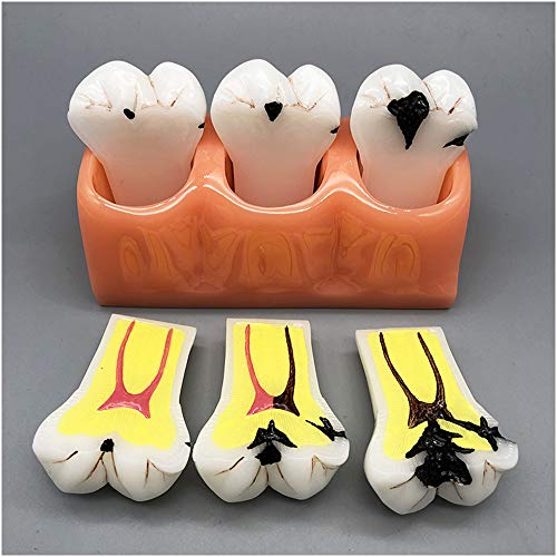 FHUILI 4X große Zähne Modell - Karies Pathologische Karies Modell - Dental Zähne Modell Shallow Karies Tiefe Karies Patient Demo Teaching Modell,A von FHUILI