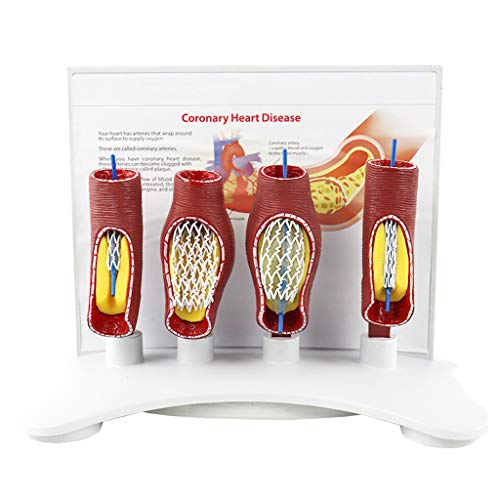 FHUILI Menschliche Vascular Stent Modell - Coronary Artery Kardiovaskuläre Verstopfung von Blutgefäßen Bracket Medical Modell - für Medizinische Ausbildung Ausbildungshilfe von FHUILI