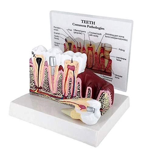 FHUILI Zähne Querschnitt Modell - Gums Modell Anatomie Zähne Modell Abnehmbare Bildung Dental-Modell - für das Studium Anzeige Teaching Medical Modell von FHUILI