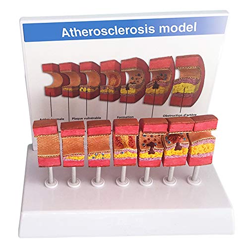 FXQ Anatomisches Modell der Arterie - Anatomisches Gefäß-Atherosklerose-Thrombus-Gefäß-Modell Anatomisches Modell der menschlichen Arterie - für das Studien-Display Lehre Medizinisches Modell von FXQ