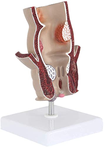 UIGJIOG Rektalpathologie Modell Hämorrhoidenmodell, Proktologie Retalkrankung Demonstration, 5X Anal Anal und Analkanalmodell Anal und Anorekt Rektal 11 * 11 * 18,5 cm von UIGJIOG