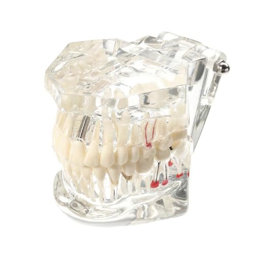 YUMILI Lehrmodell für Zahnzähne, Dental Disease Teaching Study Adult Typodont Demonstration Teeth Model New von YUMILI